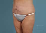 After Image: Mesh Abdominoplasty - left-front-oblique