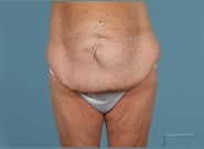 Before Image: Mesh Abdominoplasty - front