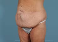 Before Image: Mesh Abdominoplasty - left-front-oblique