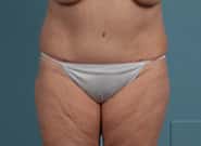 After Image: Mesh Abdominoplasty - front