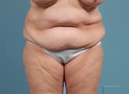 Before Image: Mesh Abdominoplasty - front