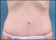 After Image: Mesh Abdominoplasty - front