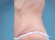 After Image: Mesh Abdominoplasty - left-side