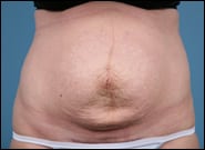 Before Image: Mesh Abdominoplasty - front