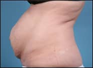 Before Image: Mesh Abdominoplasty - left-side