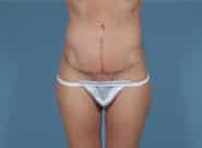After Image: Mesh Abdominoplasty - front