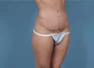 After Image: Mesh Abdominoplasty - right-front-oblique