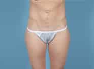 Before Image: Mesh Abdominoplasty - front