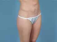 Before Image: Mesh Abdominoplasty - right-front-oblique