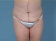 After Image: Mesh Abdominoplasty - front