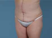 After Image: Mesh Abdominoplasty - left-front-oblique