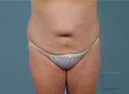Before Image: Mesh Abdominoplasty - front