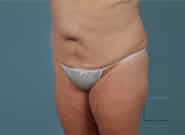 Before Image: Mesh Abdominoplasty - left-front-oblique