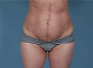 After Image: Mesh Abdominoplasty - front