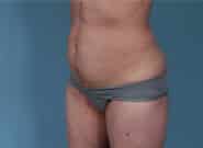 After Image: Mesh Abdominoplasty - left-front-oblique