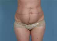 Before Image: Mesh Abdominoplasty - front