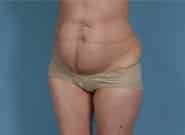 Before Image: Mesh Abdominoplasty - left-front-oblique