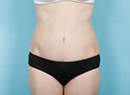 After Image: Mesh Abdominoplasty - front