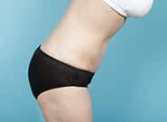 After Image: Mesh Abdominoplasty - right-side