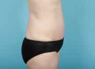After Image: Mesh Abdominoplasty - right-side