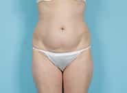 Before Image: Mesh Abdominoplasty - front