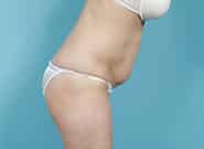 Before Image: Mesh Abdominoplasty - right-side