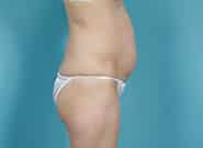 Before Image: Mesh Abdominoplasty - right-side