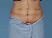 After Image: Mesh Abdominoplasty - front