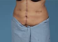 After Image: Mesh Abdominoplasty - left-front-oblique