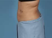 After Image: Mesh Abdominoplasty - left-side
