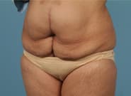 Before Image: Mesh Abdominoplasty - left-front-oblique