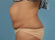 Before Image: Mesh Abdominoplasty - left-side