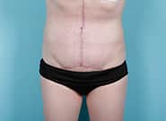 After Image: Mesh Abdominoplasty - front