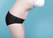 After Image: Mesh Abdominoplasty - right-side