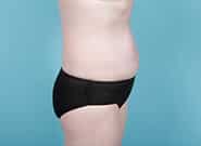 After Image: Mesh Abdominoplasty - right-side