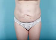 Before Image: Mesh Abdominoplasty - front