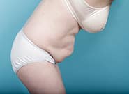 Before Image: Mesh Abdominoplasty - right-side