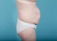Before Image: Mesh Abdominoplasty - right-side