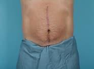 After Image: Mesh Abdominoplasty - front