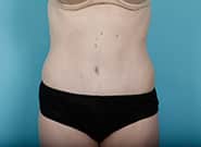 After Image: Mesh Abdominoplasty - front