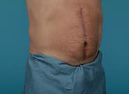 After Image: Mesh Abdominoplasty - right-front-oblique