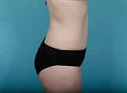 After Image: Mesh Abdominoplasty - right-side