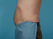 After Image: Mesh Abdominoplasty - left-side