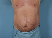 Before Image: Mesh Abdominoplasty - front