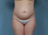 Before Image: Mesh Abdominoplasty - front