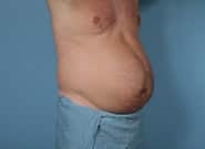Before Image: Mesh Abdominoplasty - right-front-oblique