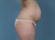 Before Image: Mesh Abdominoplasty - right-side
