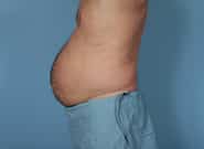 Before Image: Mesh Abdominoplasty - left-side