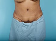 After Image: Mesh Abdominoplasty - front