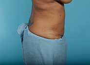 After Image: Mesh Abdominoplasty - right-side